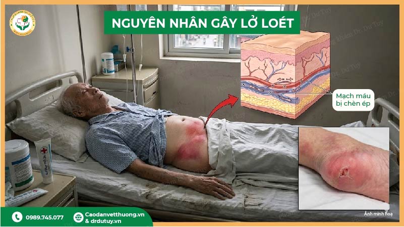 nguyên nhân gây lở loét ngoài da