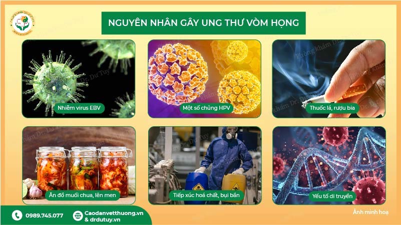 nguyên nhân gây ung thư vòm họng virus ebv hpv