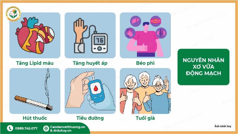 nguyên nhân gây xơ vữa động mạch