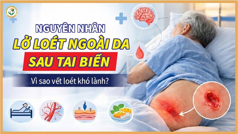 nguyên nhân lở loét ngoài da sau tai biến