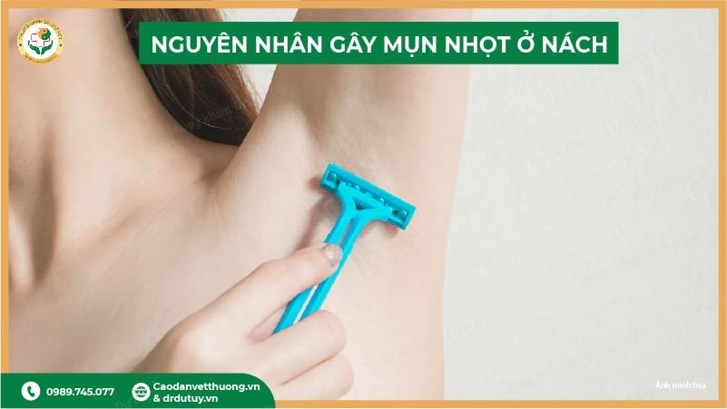 nguyên nhân mụn nhọt nách cạo lông