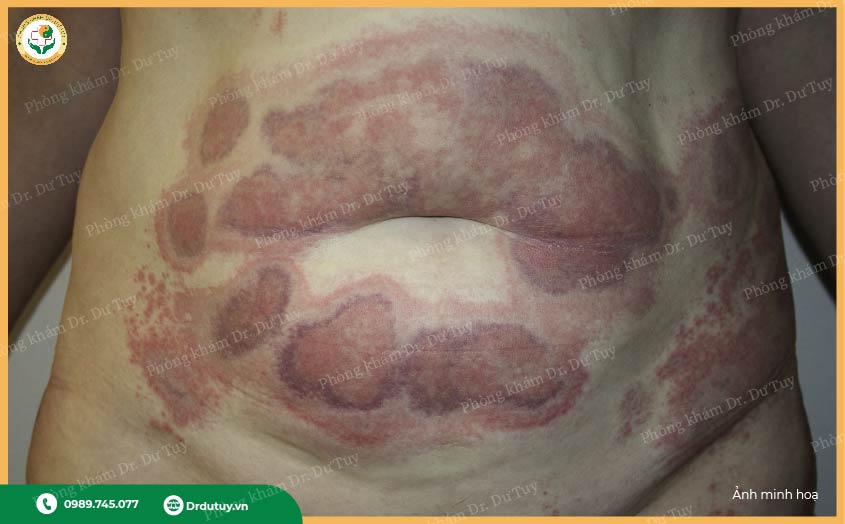 nguyên nhân viêm da sau phẫu thuật thẩm mỹ