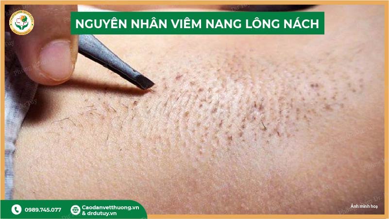 nguyên nhân viêm nang lông nách