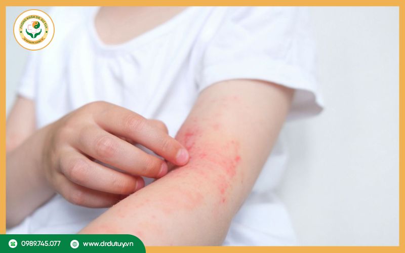 Nhiễm trùng da do nấm