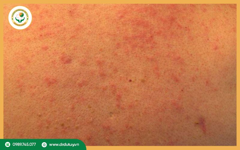 Chẩn đoán bệnh nhiễm khuẩn da