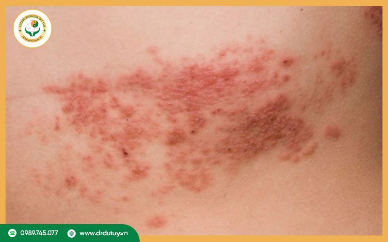 Các phương pháp điều trị nhiễm trùng da