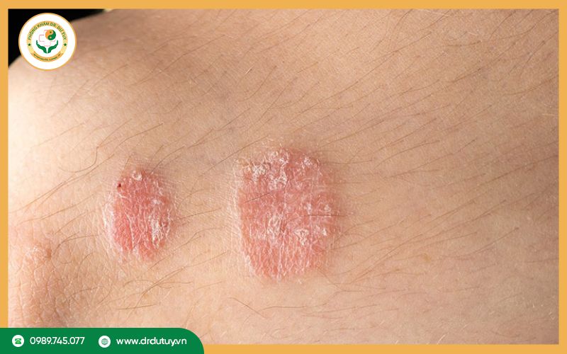 Các phương pháp điều trị nhiễm trùng da