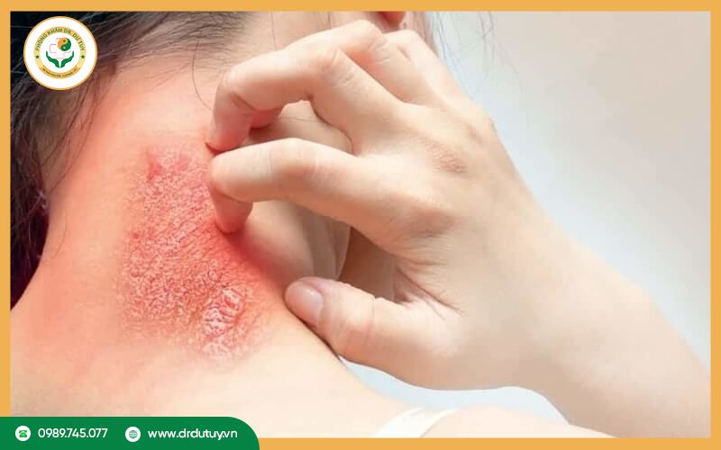 Nhiễm khuẩn da và mô mềm là gì ?