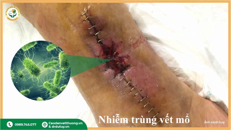 nhiễm khuẩn vết mổ sau phẫu thuật