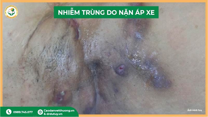 nhiễm trùng áp xe nách
