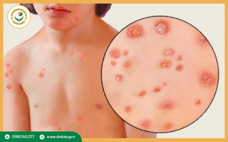 Nhiễm trùng da có lây không? Cách phòng ngừa hiệu quả