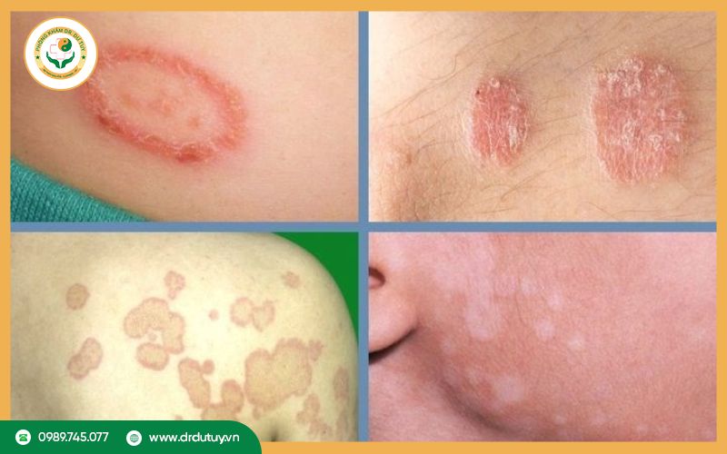 Một số loại nhiễm trùng da dễ lây lan