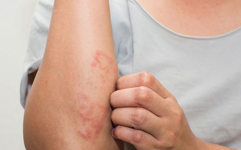 Nhiễm trùng da bao lâu thì khỏi?