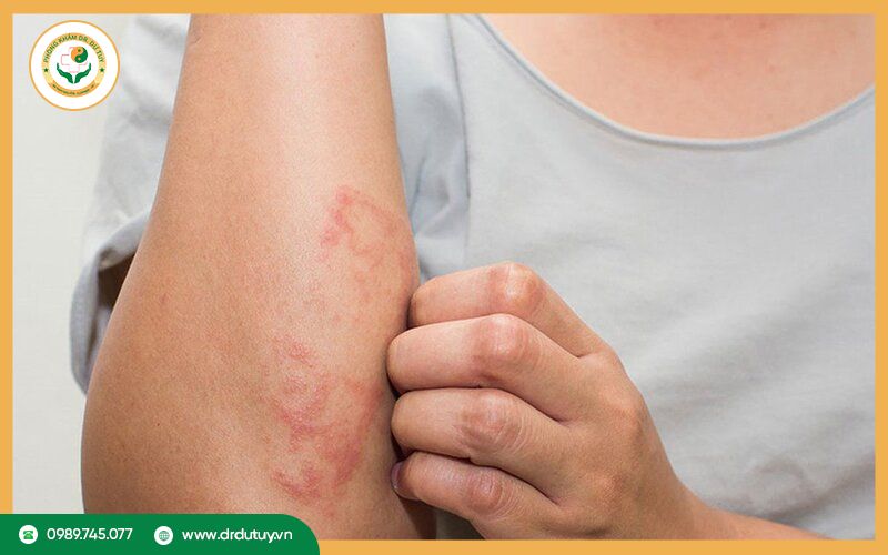 Nhiễm trùng da có tự khỏi không?