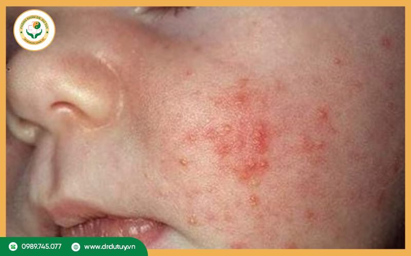 Các bệnh nhiễm trùng da ở trẻ em thường gặp