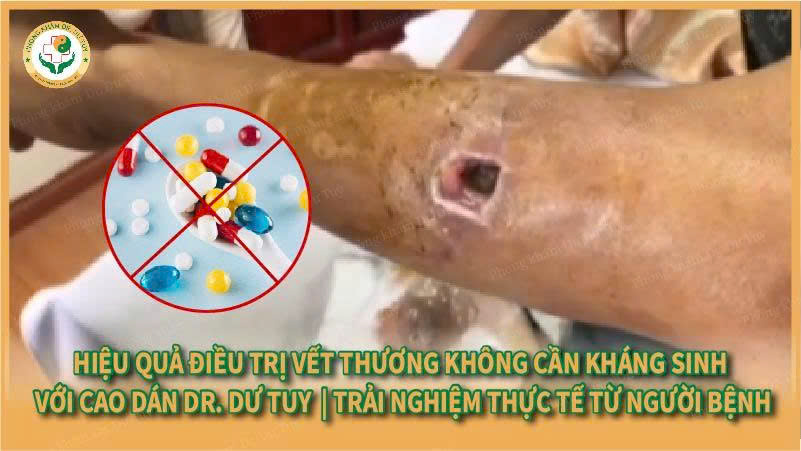 Hiệu quả điều trị vết thương không cần kháng sinh với Cao dán Dr. Dư Tuy | Trải nghiệm thực tế từ người bệnh