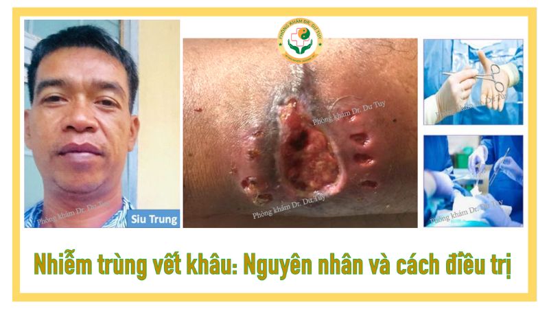 Nhiễm trùng vết khâu: Nguyên nhân, dấu hiệu và cách điều trị hiệu quả