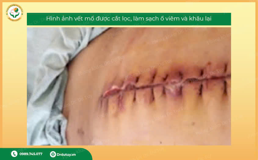 nhiễm trùng vết mổ