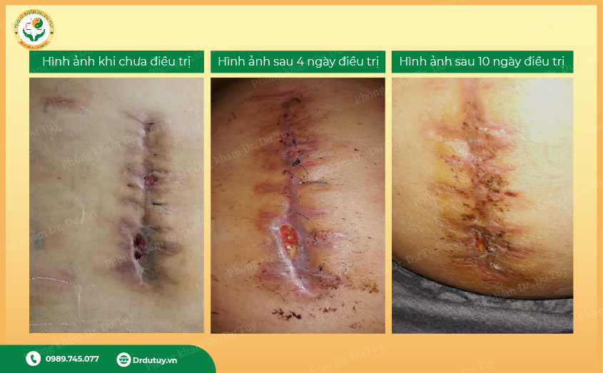nhiễm tùng vết mổ