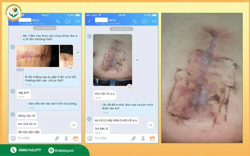 nhiễm trùng vết mổ