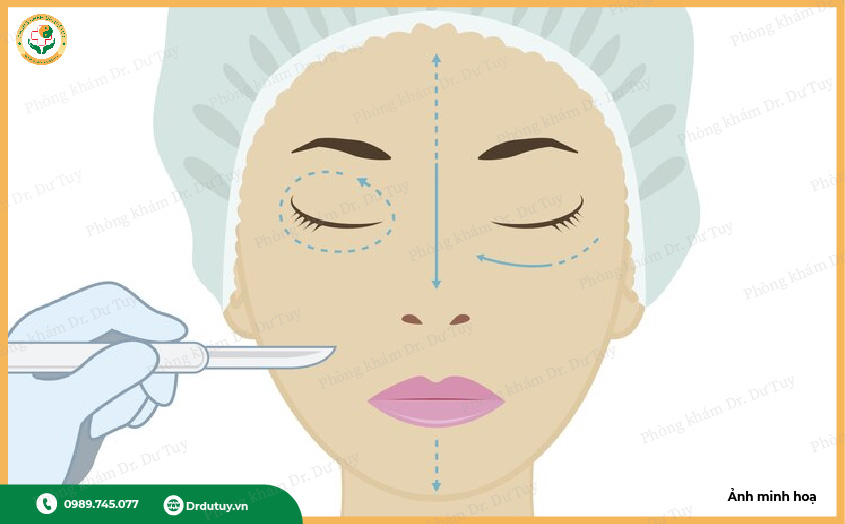 nhiễm trùng vết mổ thẩm mỹ