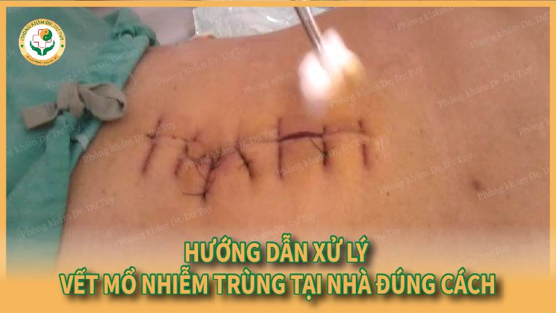 Hướng dẫn cách trị vết thương mổ nhiễm trùng tại nhà an toàn