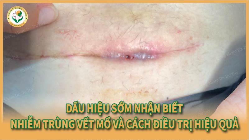 Dấu hiệu sớm nhận biết nhiễm trùng vết mổ và cách điều trị hiệu quả