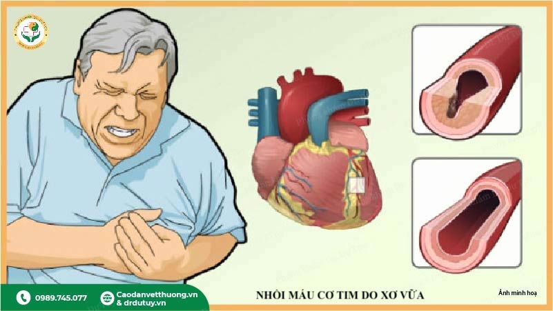 nhồi máu cơ tim do xơ vữa động mạch vành