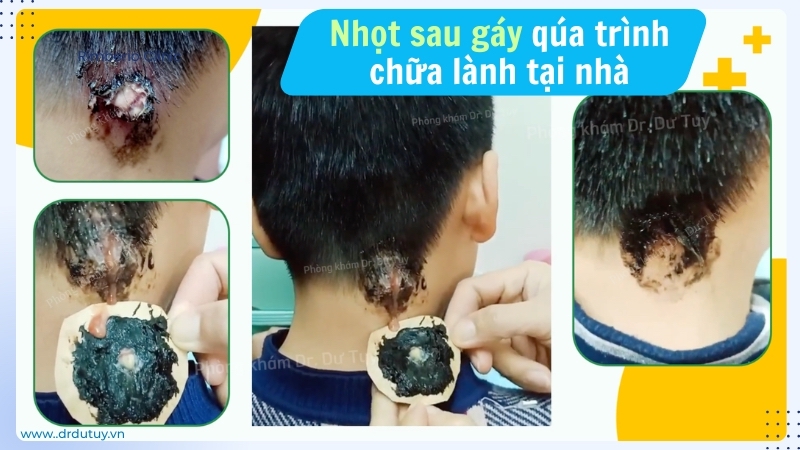 nhọt sau gáy quá trình lành thương