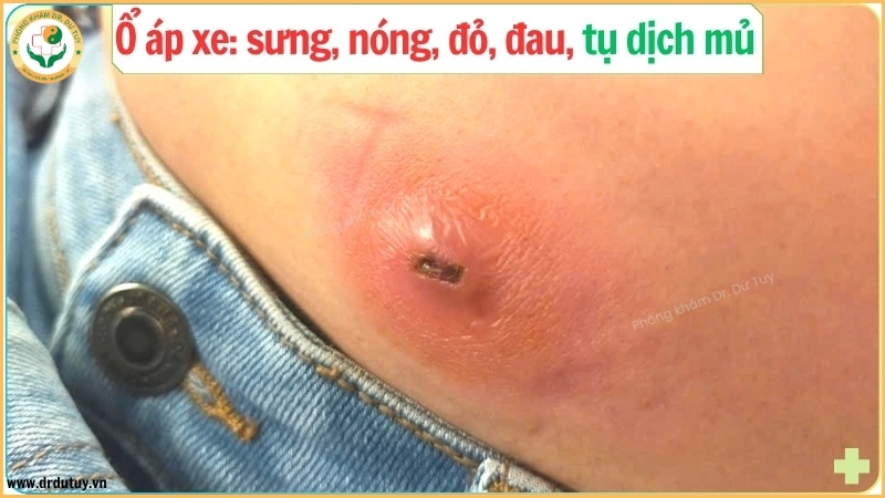 ổ áp xe ngoài da sưng nóng đỏ đau tụ mủ