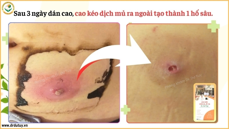 ổ áp xe thoát dịch sau 3 ngày