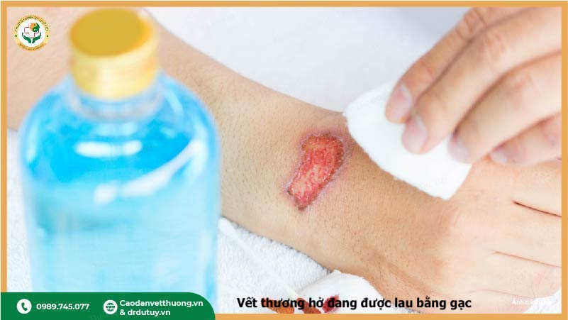 oxy già làm lâu lành vết thương