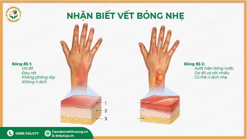 phân biệt bỏng độ 1 và bỏng độ 2 nông