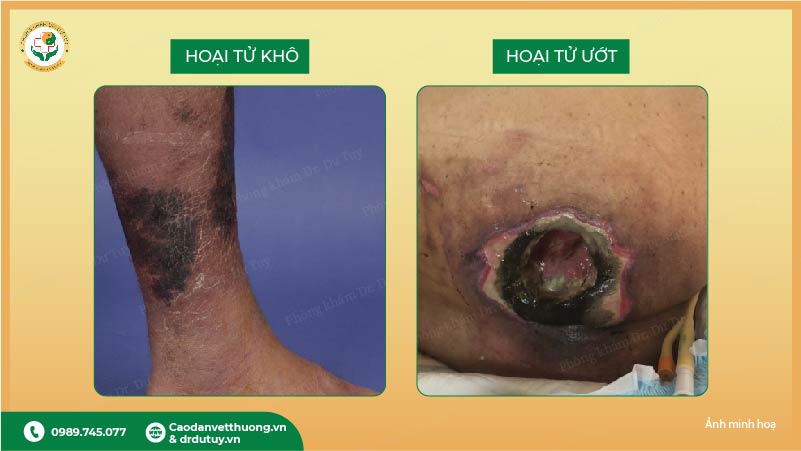 phân biệt hoại tử khô và hoại tử ướt