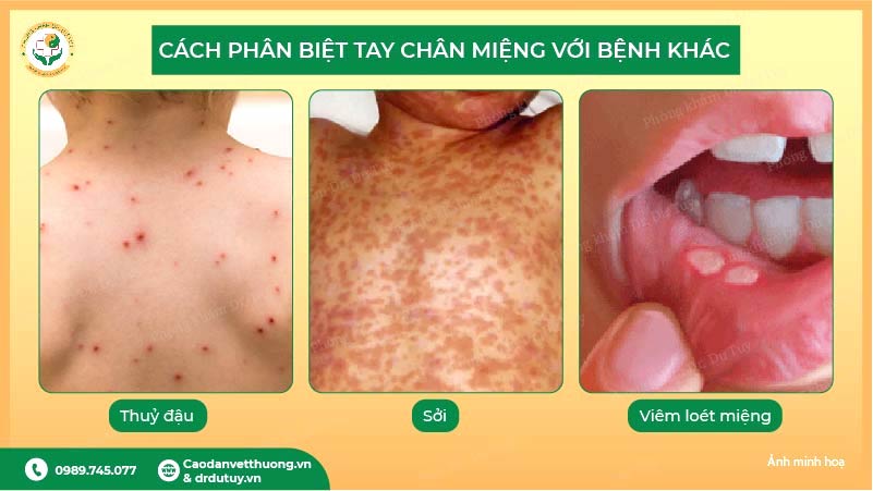 phân biệt tay chân miệng với thuỷ đậu sởi loét miệng
