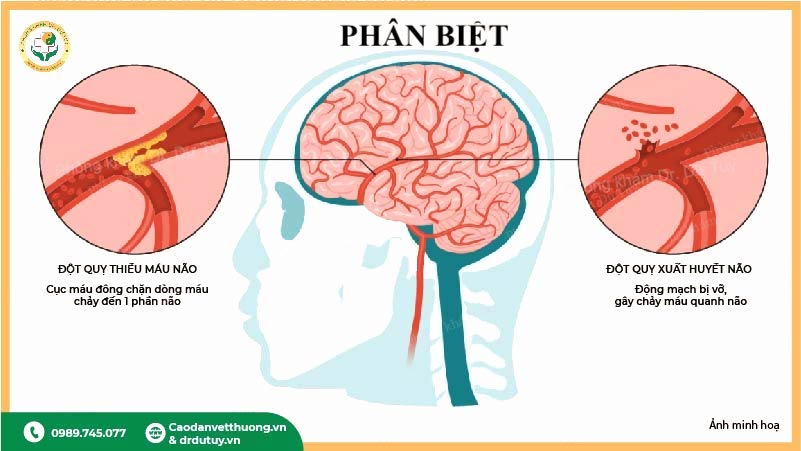 phân biệt thiếu máu và xuất huyết não