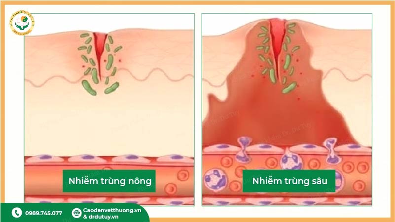 phân loại nhiễm trùng vết mổ nông và sâu