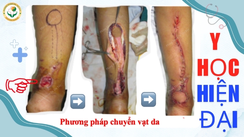 phẫu thuật ghép da bỏng nặng chuyển vạt da