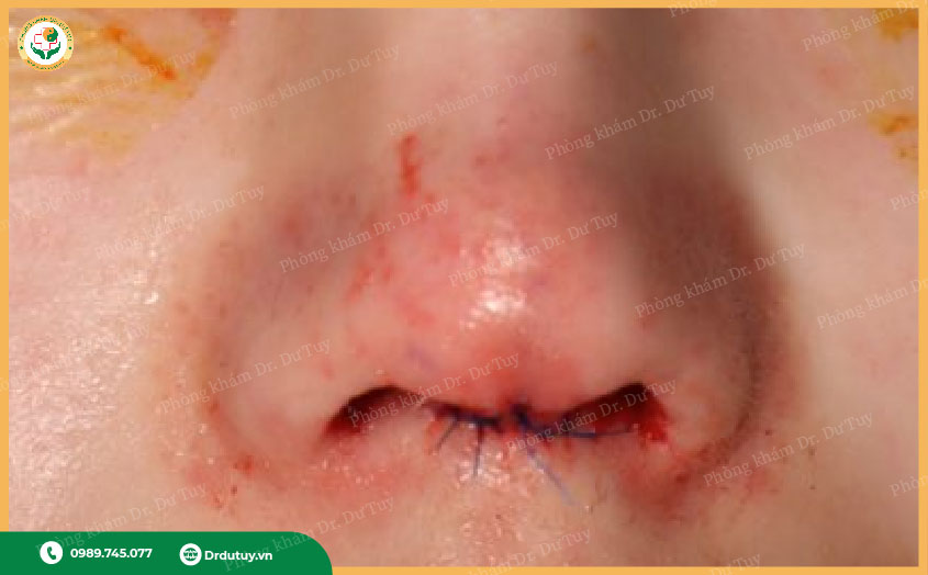 phẫu thuật nâng mũi