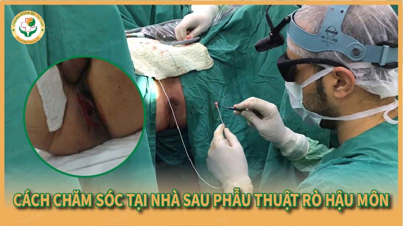 Cách chăm sóc tại nhà sau phẫu thuật rò hậu môn