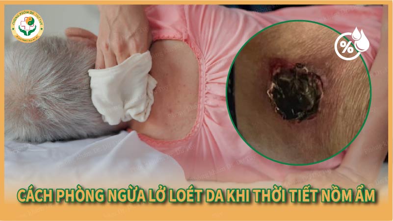 Cách phòng ngừa lở loét da khi thời tiết nồm ẩm