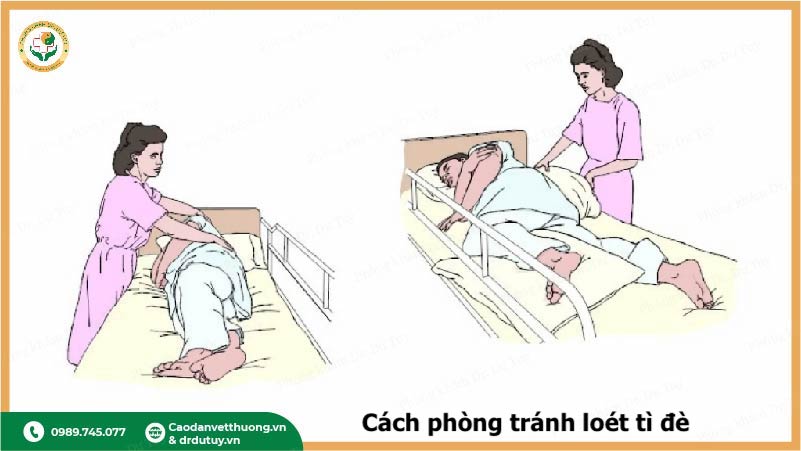 phòng ngừa loét tì đè