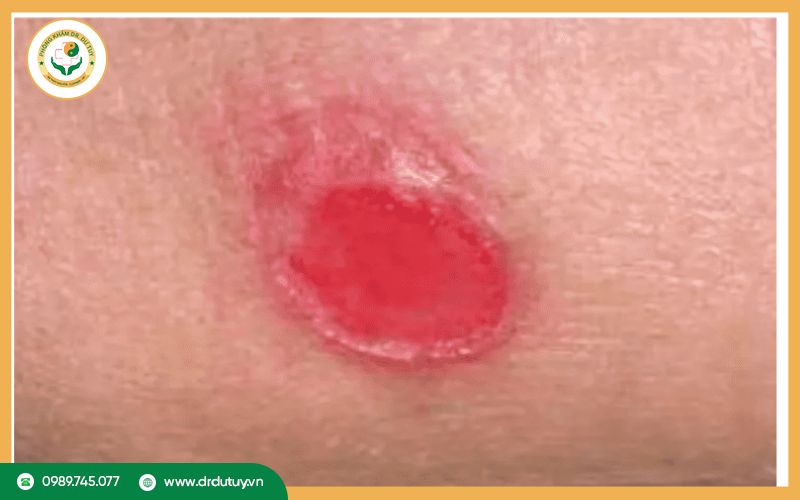 Cách phòng ngừa loét tì đè hiệu quả