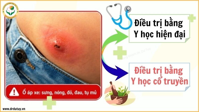 phương pháp điều trị áp xe ngoài da