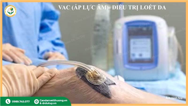 phương pháp VAC điều trị vết thương áp lực âm