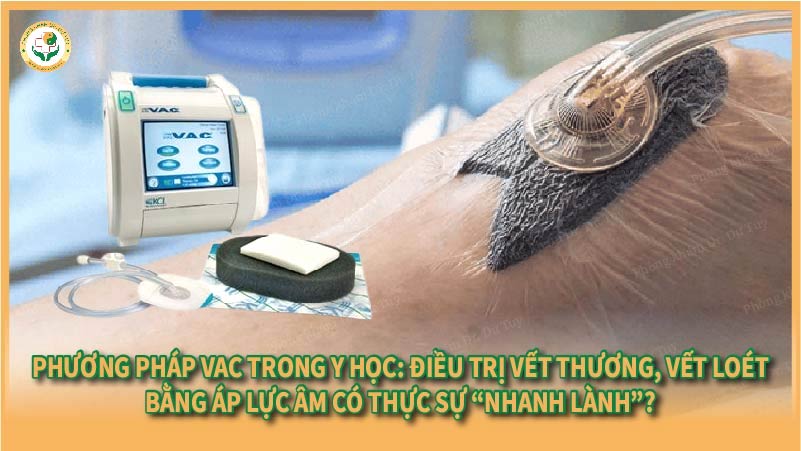 Phương pháp VAC trong y học: Điều trị vết thương, vết loét, bằng áp lực âm có thực sự “nhanh lành”?