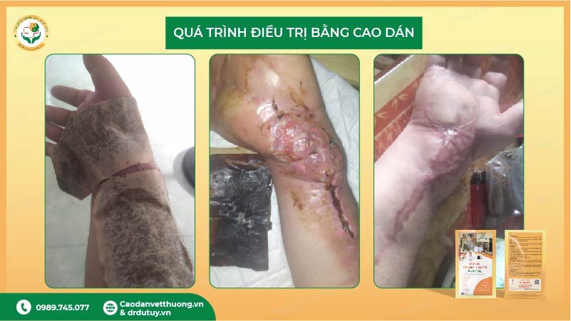 quá trình điều trị lở loét sau phẫu thuật