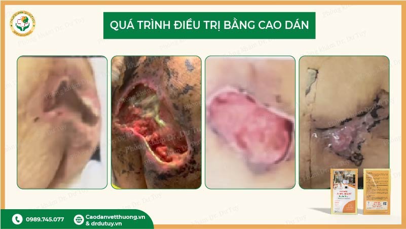 quá trình điều trị loét da