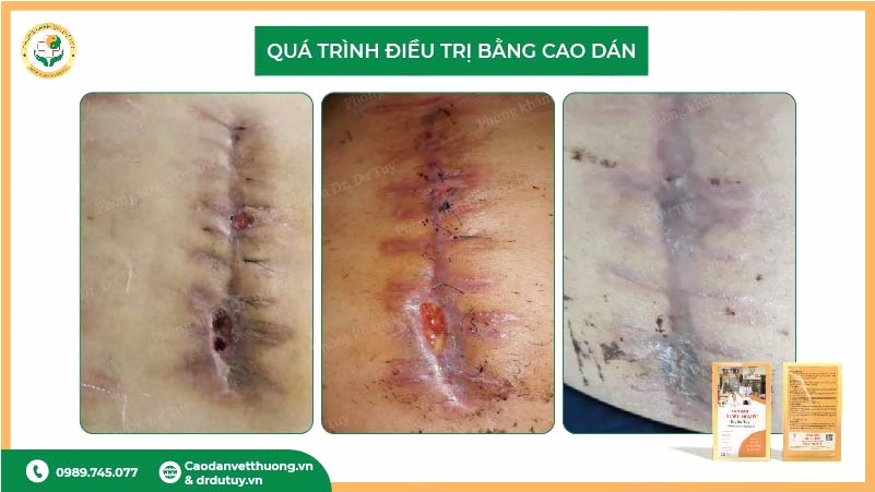 quá trình điều trị nhiễm trùng vết mổ bằng cao dán