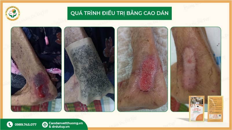 quá trình điều trị vết thương bằng cao dán